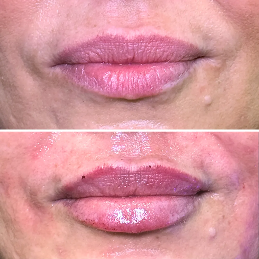LipFix: Hydrate